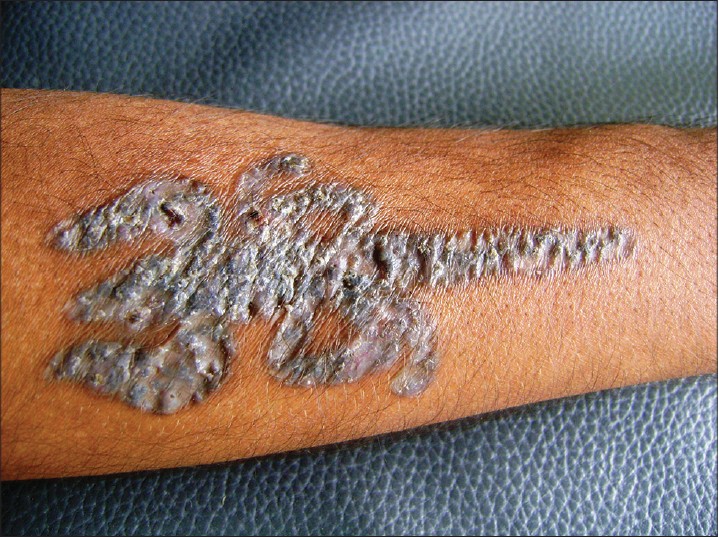 Pulmonary sarcoidosis presenting as a granulomatous tattoo reaction