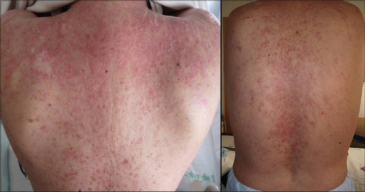 chronic cutaneous lupus