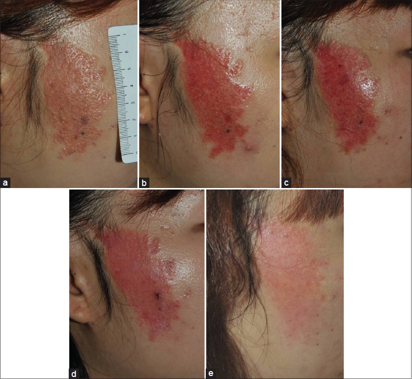 epidermal nevus removal