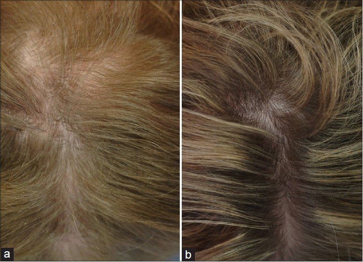 The effectiveness of finasteride and dutasteride used for 3 years in women  with androgenetic alopecia - Indian Journal of Dermatology, Venereology and  Leprology