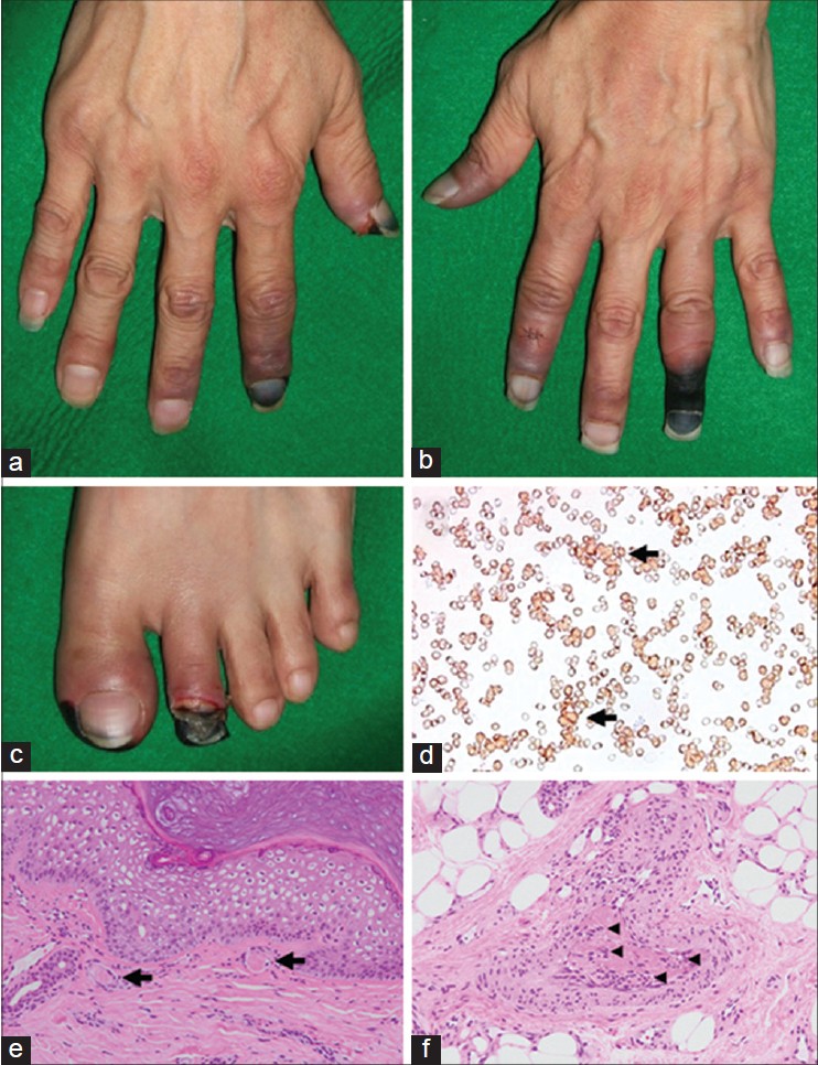 Cold Agglutinin Disease Associated Digital Gangrene Treated With Plasmapheresis Indian Journal