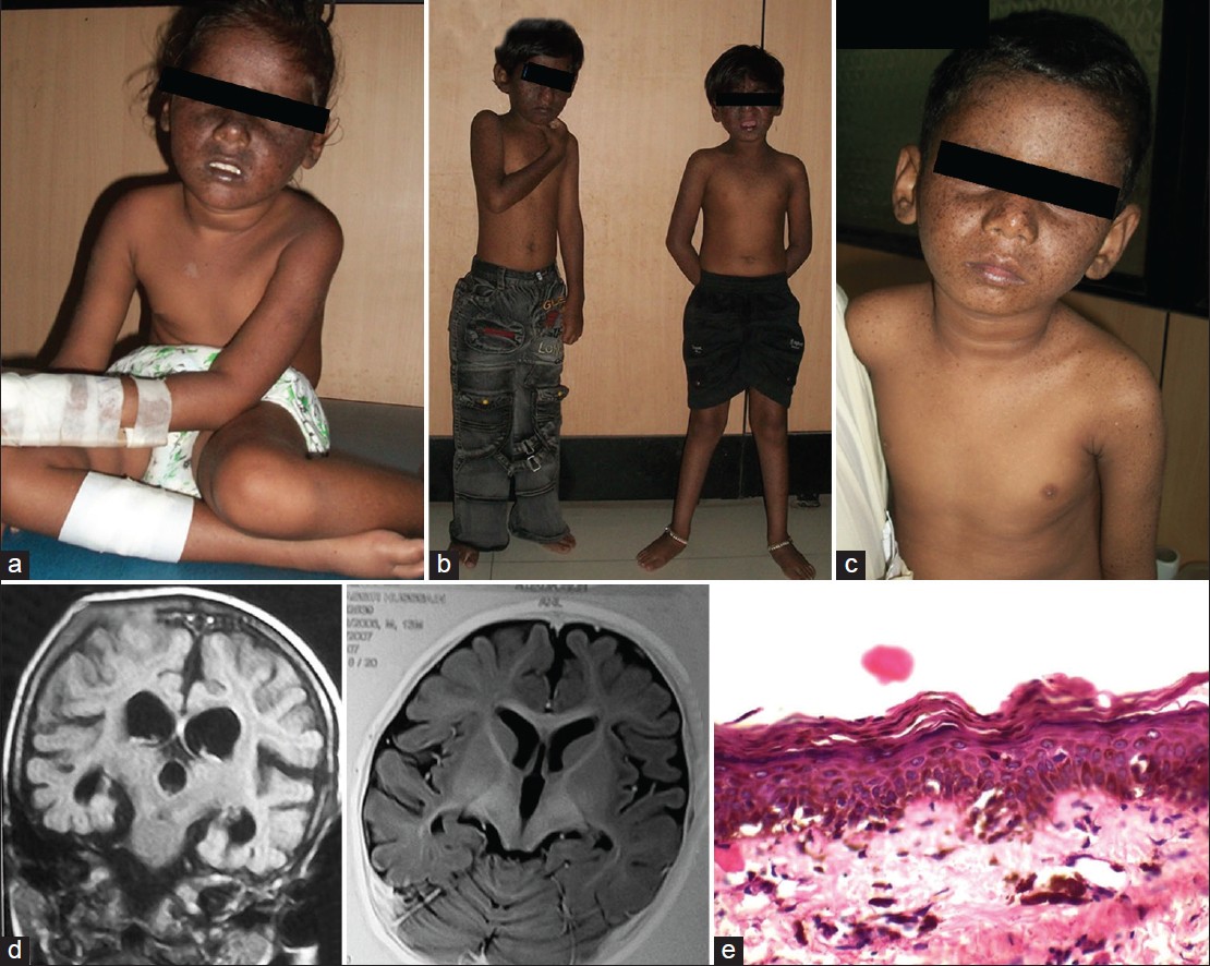 case study on xeroderma pigmentosum