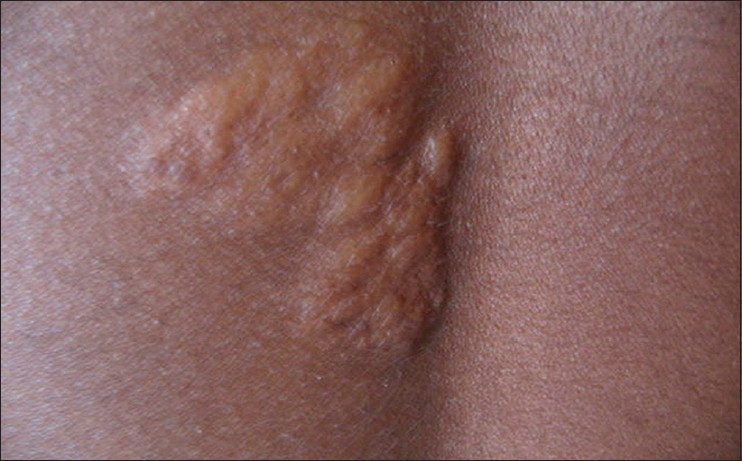 ash leaf tuberous sclerosis