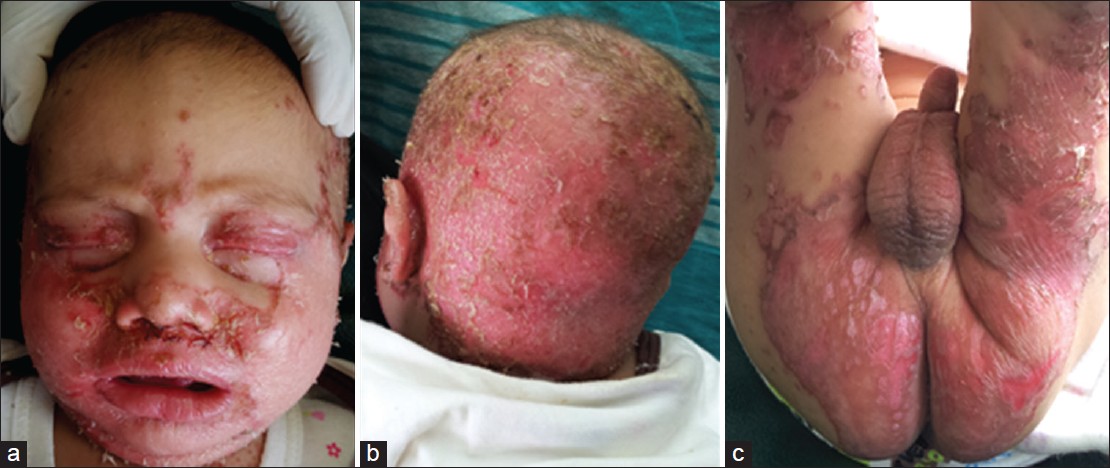 zinc deficiency acrodermatitis enteropathica