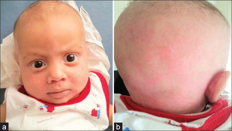 zinc deficiency acrodermatitis enteropathica