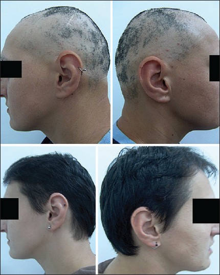 Intravenous methylprednisolone pulse therapy in severe alopecia areata -  Indian Journal of Dermatology, Venereology and Leprology