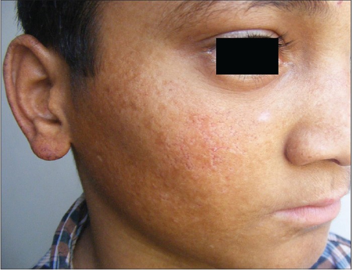 rothmund thomson syndrome