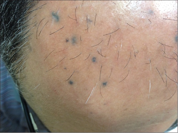 Eruptive blue nevi - Indian Journal of Dermatology, Venereology