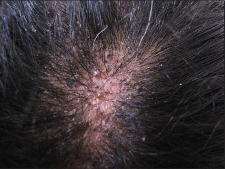 Black dot tinea capitis caused by <i>trichophyton rubrum</i> in an adult  female presenting with cicatricial alopecia - Indian Journal of  Dermatology, Venereology and Leprology