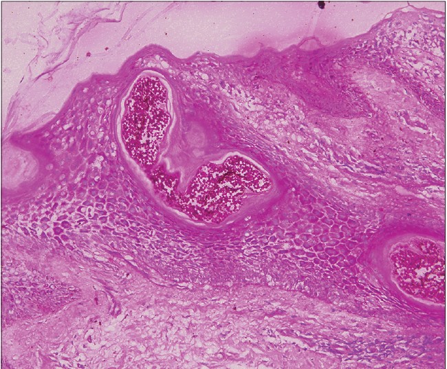 Black dot tinea capitis caused by <i>trichophyton rubrum</i> in an adult  female presenting with cicatricial alopecia - Indian Journal of  Dermatology, Venereology and Leprology