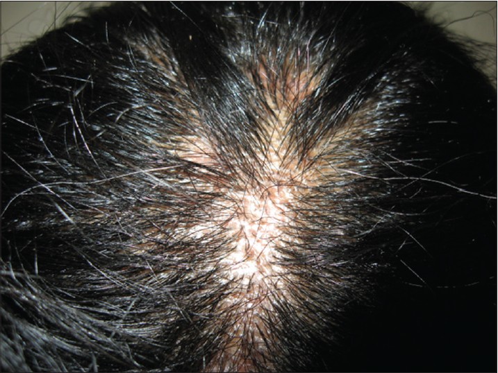 Black dot tinea capitis caused by <i>trichophyton rubrum</i> in an adult  female presenting with cicatricial alopecia - Indian Journal of  Dermatology, Venereology and Leprology