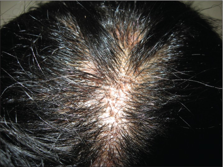 Tinea Capitis Caused by Trichophyton Tonsurans