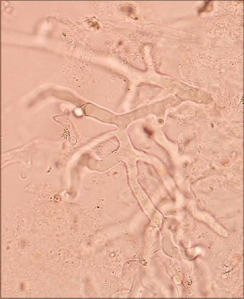 Cutaneous mucormycosis of scalp and eyelids in a child with type I ...