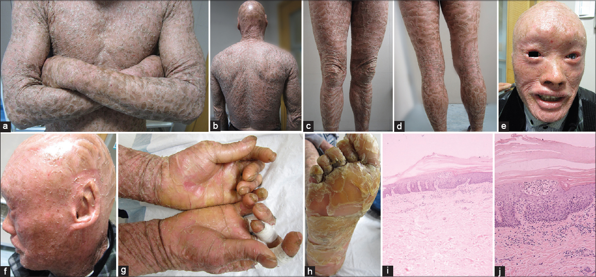 lamellar ichthyosis treatment