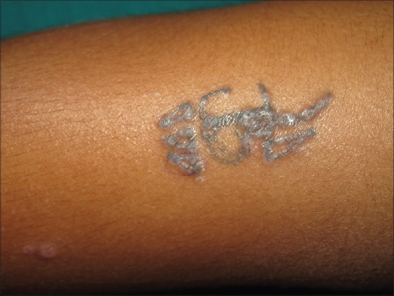 Red Scaly Rash Following Tattoo Application  MDedge Dermatology