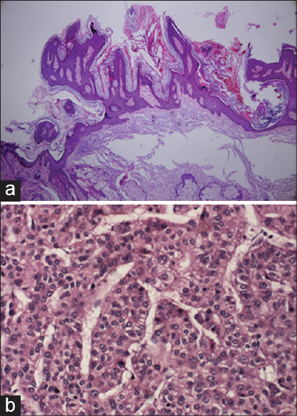 icd 10 codes for malignant pleural effusion