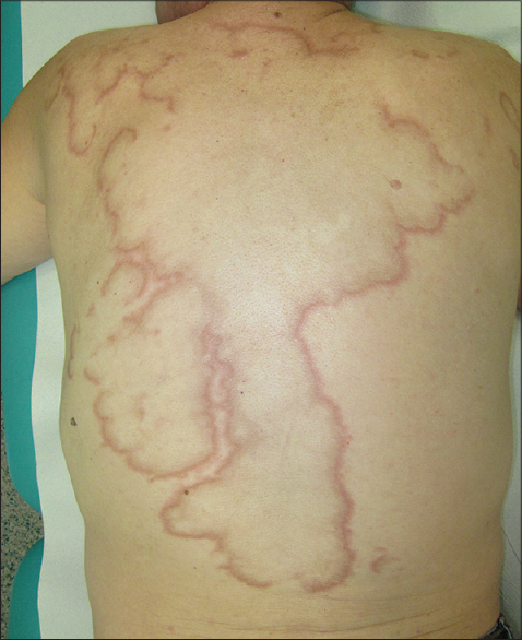 Interstitial Granulomatous Dermatitis (Interstitial granulomatous  dermatitis with arthritis, Ackerman's syndrome, Ackerman's dermatitis -  Dermatology Advisor