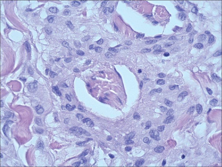 Interstitial Granulomatous Dermatitis Due To Borreliosis Indian