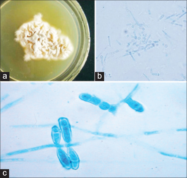 Septate fungal filaments in a clinical sample (nail). Wet mount, KOH +... |  Download Scientific Diagram