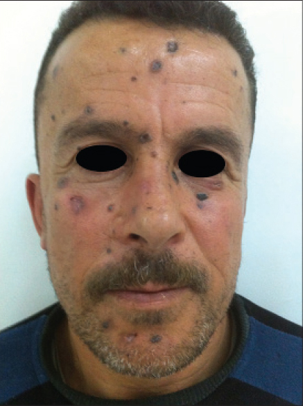 nevoid basal cell carcinoma syndrome