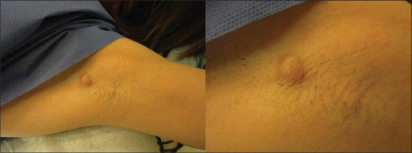 Breast carcinoma arising in ectopic breast tissue presenting as an  enlarging axillary nodule - Indian Journal of Dermatology, Venereology and  Leprology