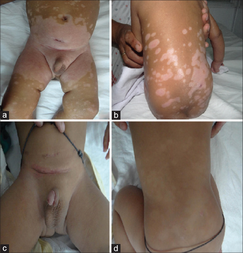 Diaper dermatitis with psoriasiform id eruptions - Indian Journal of  Dermatology, Venereology and Leprology