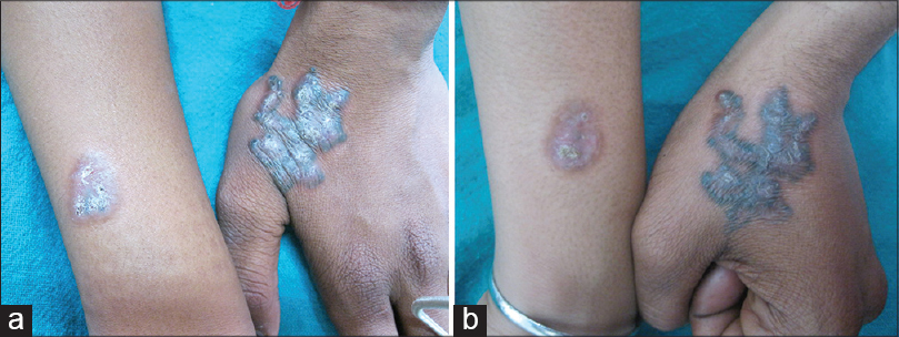 Clinicodermoscopic and immunopathological profile of non-infectious  non-eczematous inflammatory tattoo reactions: A retrospectiv