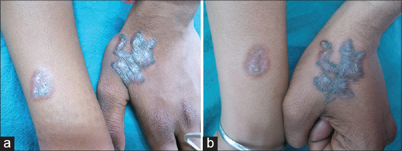 Sarcoidosis: Causes, Symptoms, Diagnosis & Treatment