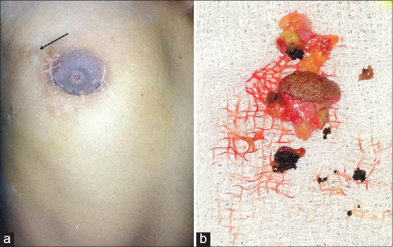 Histopathologic appearance of Black grain mycetoma, a fungal pathogen which  enters the human body through a traumatic wound, 1972. Image courtesy  CDC/Dr. Libero Ajello Stock Photo - Alamy