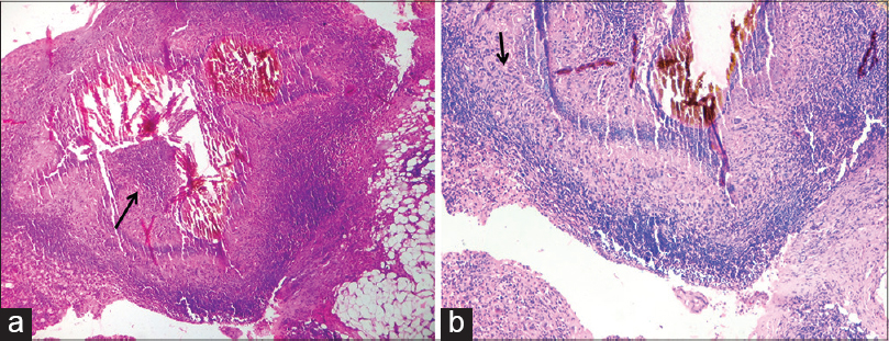 Histopathologic appearance of Black grain mycetoma, a fungal pathogen which  enters the human body through a traumatic wound, 1972. Image courtesy  CDC/Dr. Libero Ajello Stock Photo - Alamy