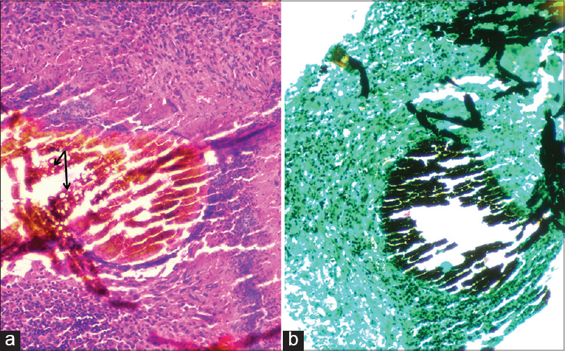 Histopathologic appearance of Black grain mycetoma, a fungal pathogen which  enters the human body through a traumatic wound, 1972. Image courtesy  CDC/Dr. Libero Ajello Stock Photo - Alamy