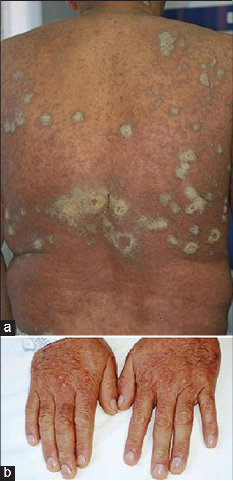 Norwegian Scabies Histology