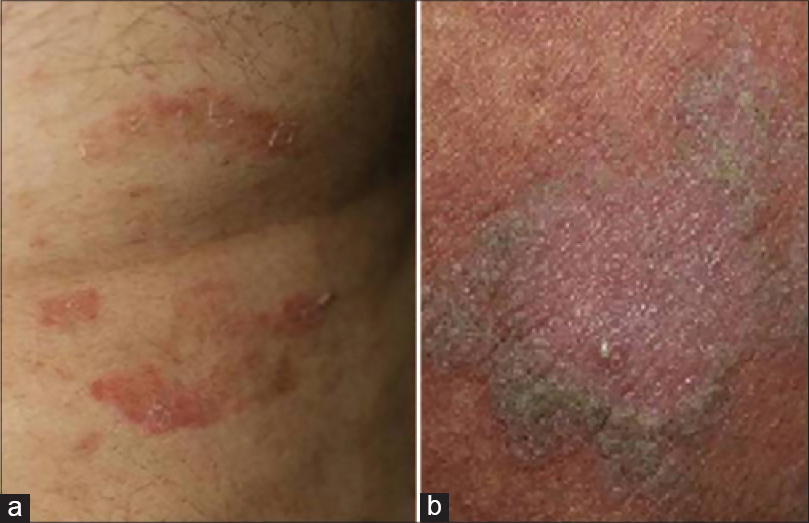 Scabies in malay