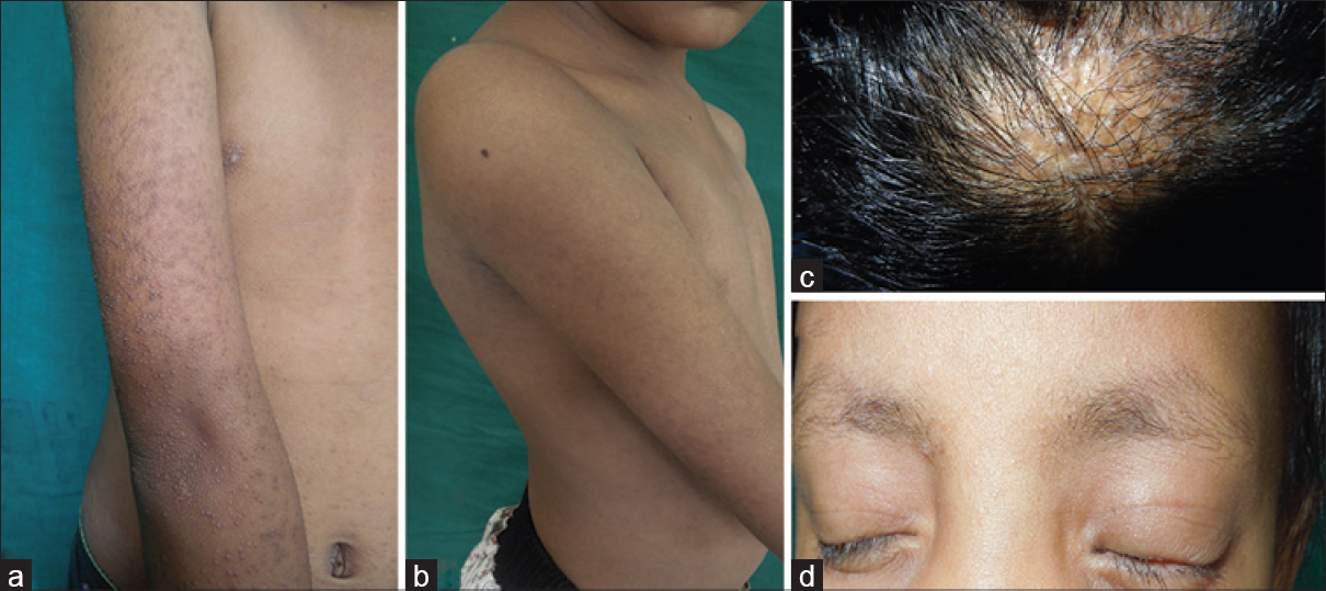 follicular hyperkeratosis scalp