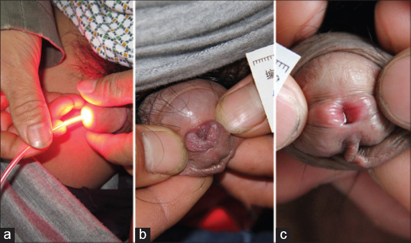 Condyloma around urethra