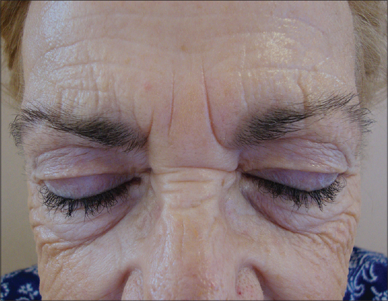 Approach to inherited hypertrichosis: A brief review - Indian Journal of Dermatology, Venereology and Leprology
