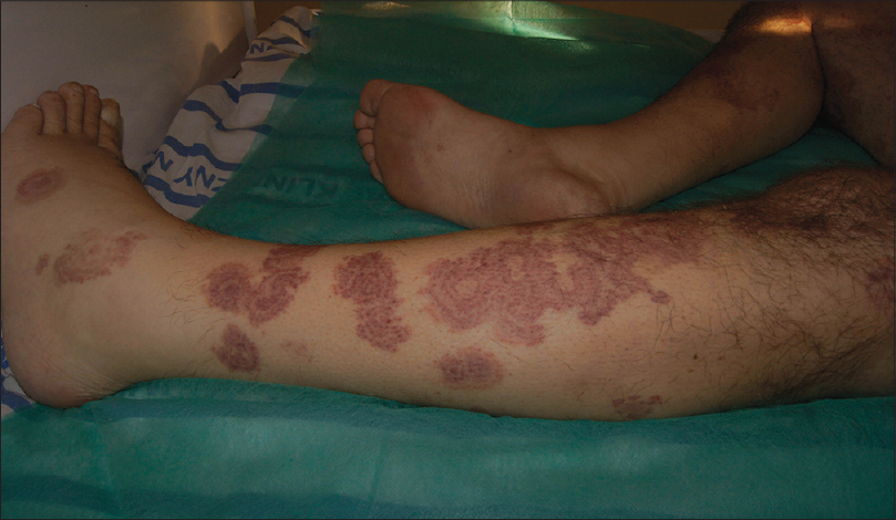 erythema gyratum repens