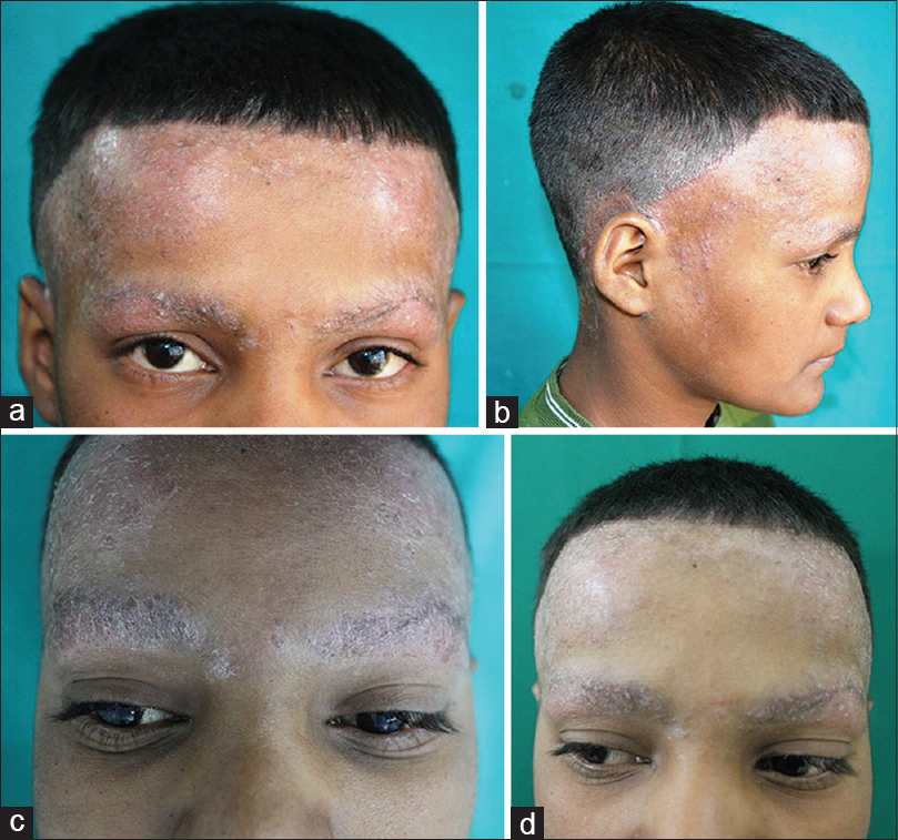 Keratosis Follicularis Scalp