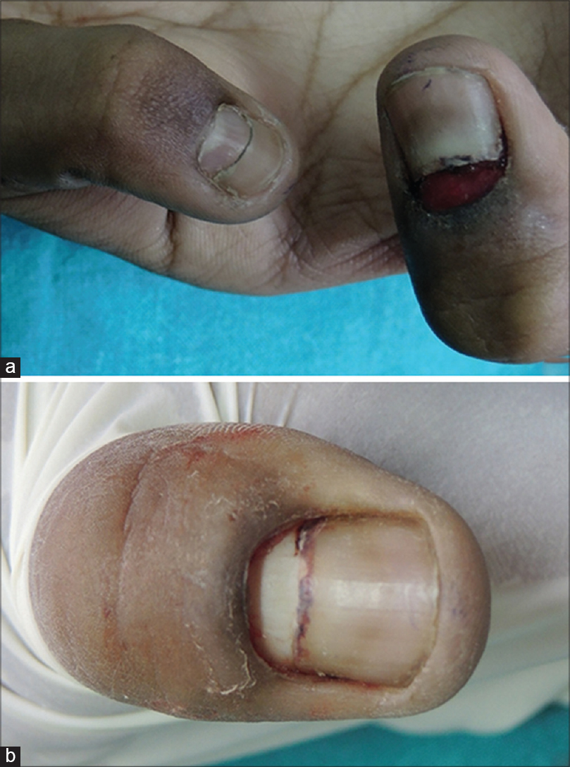 pyogenic granuloma nail