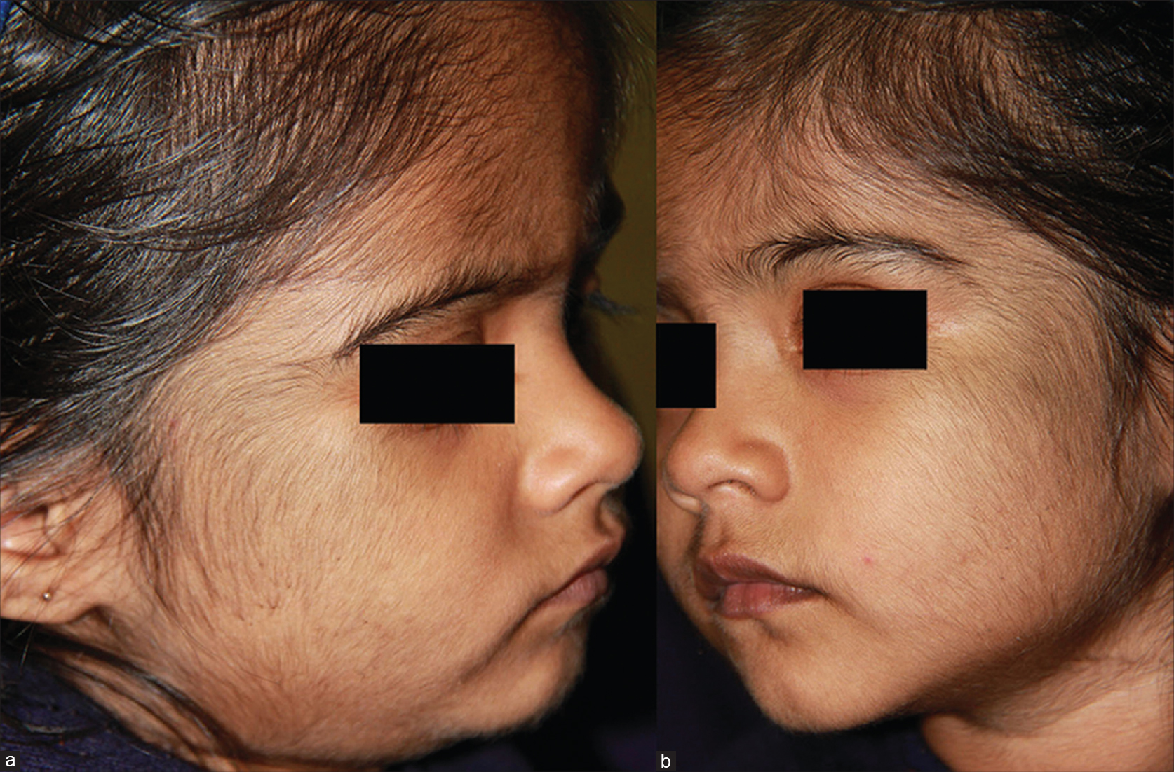 Minoxidil-induced hypertrichosis in a 4-year-old child - Indian of Dermatology, Venereology and Leprology