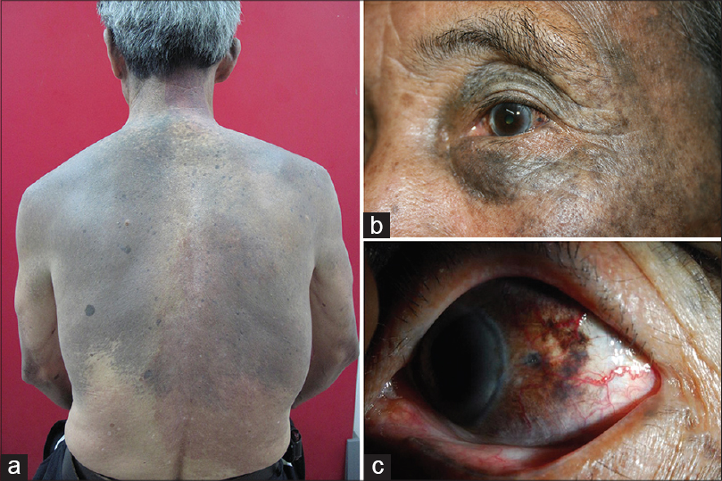 Diffuse Melanosis Cutis