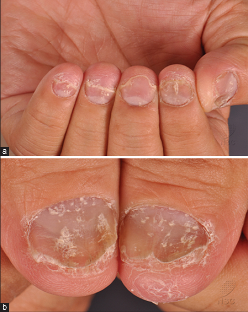 onycholysis psoriasis