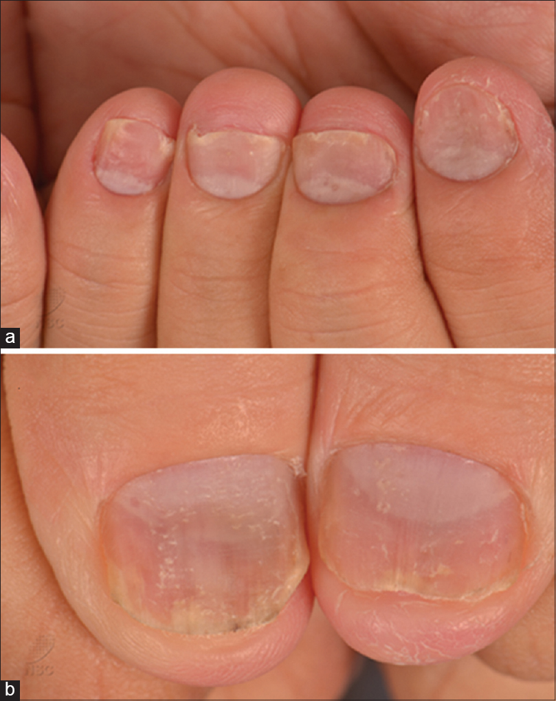 Table 5 from [Diagnosis and management of nail psoriasis]. | Semantic  Scholar