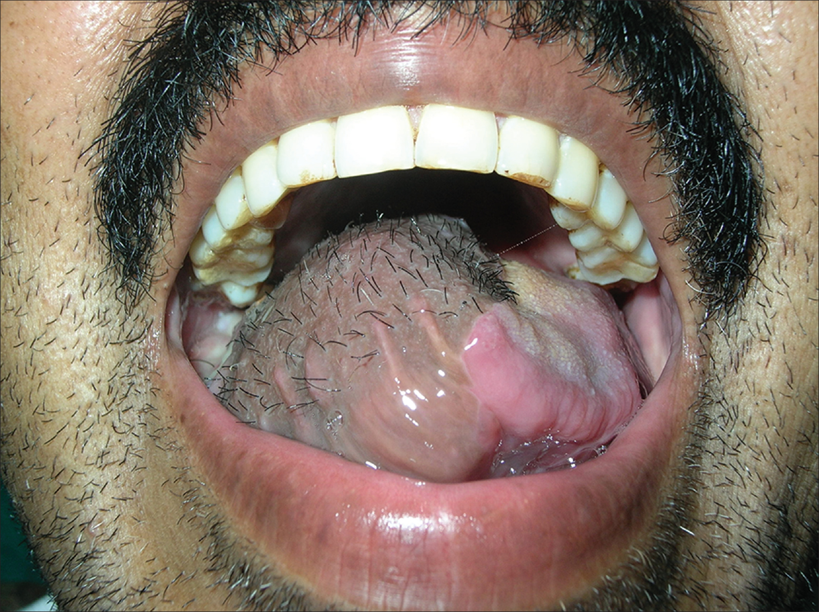 Hairy tongue  DermNet