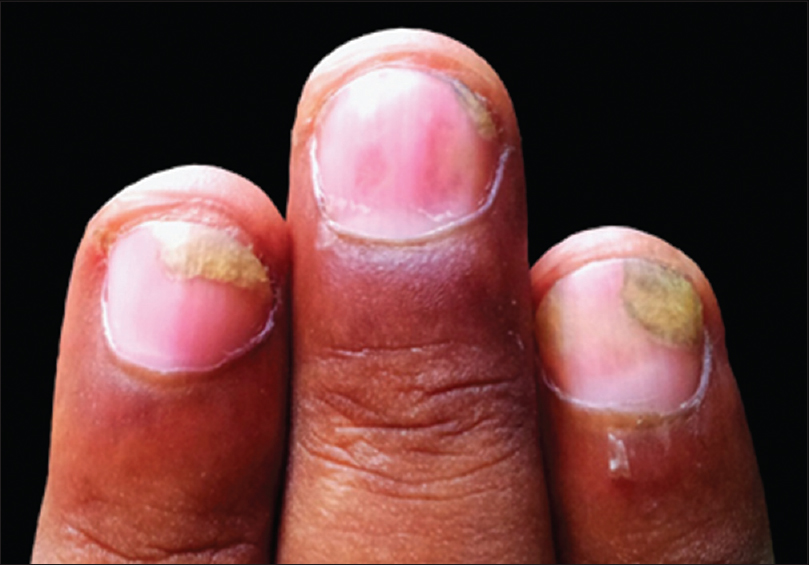 Nail Psoriasis Treatment in Ayurveda