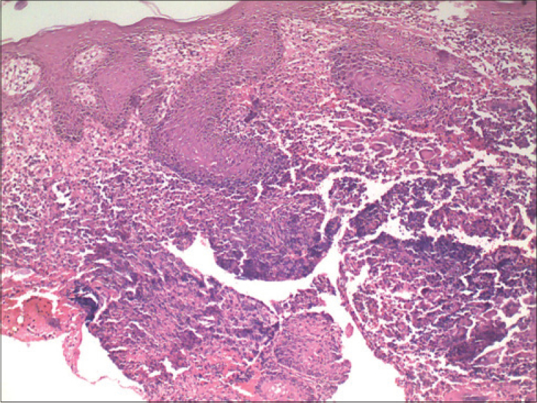 gummas histology