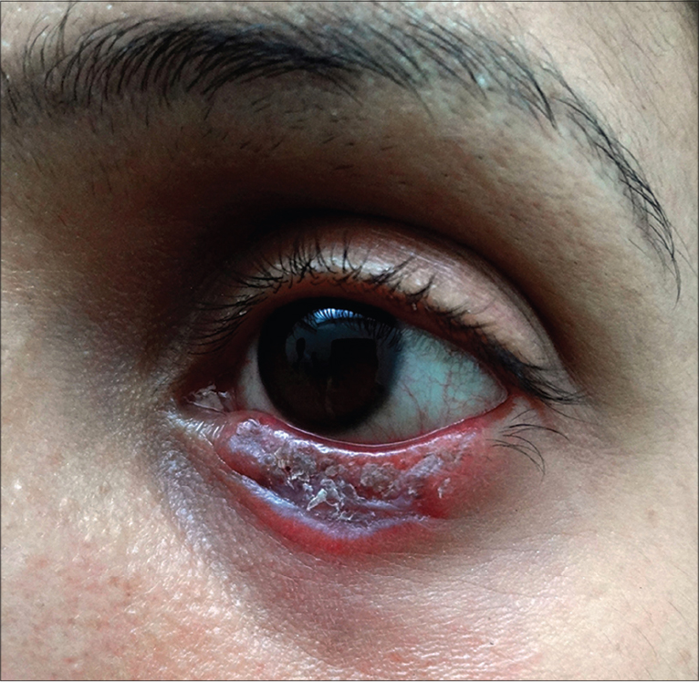 Isolated Discoid Lupus Erythematosus Of The Lower Eyelid Indian Journal Of Dermatology 2421