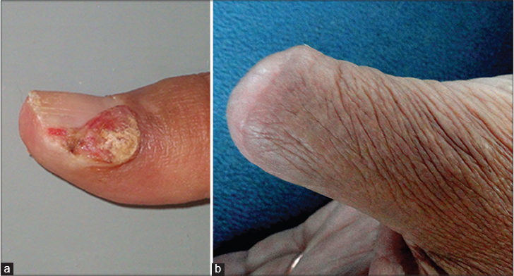 pyogenic granuloma nail