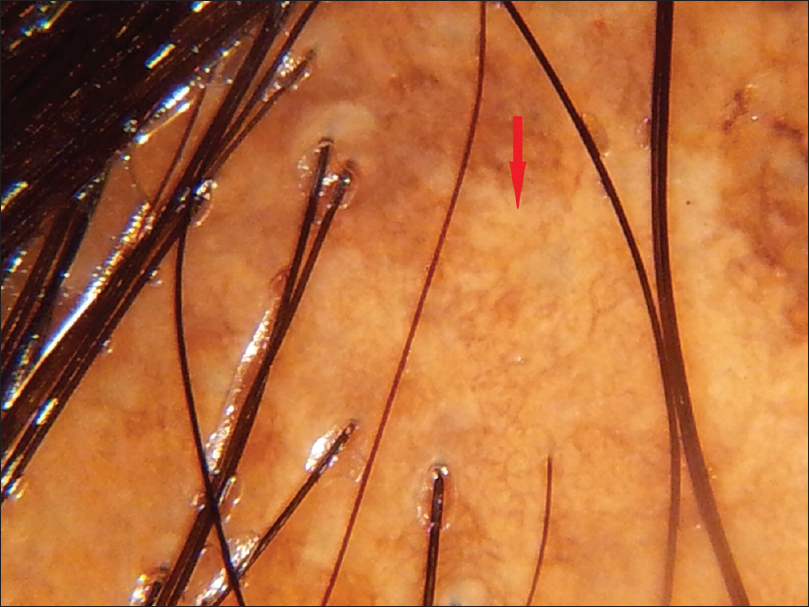 Relevance Of Trichoscopy In The Differential Diagnosis Of Alopecia A