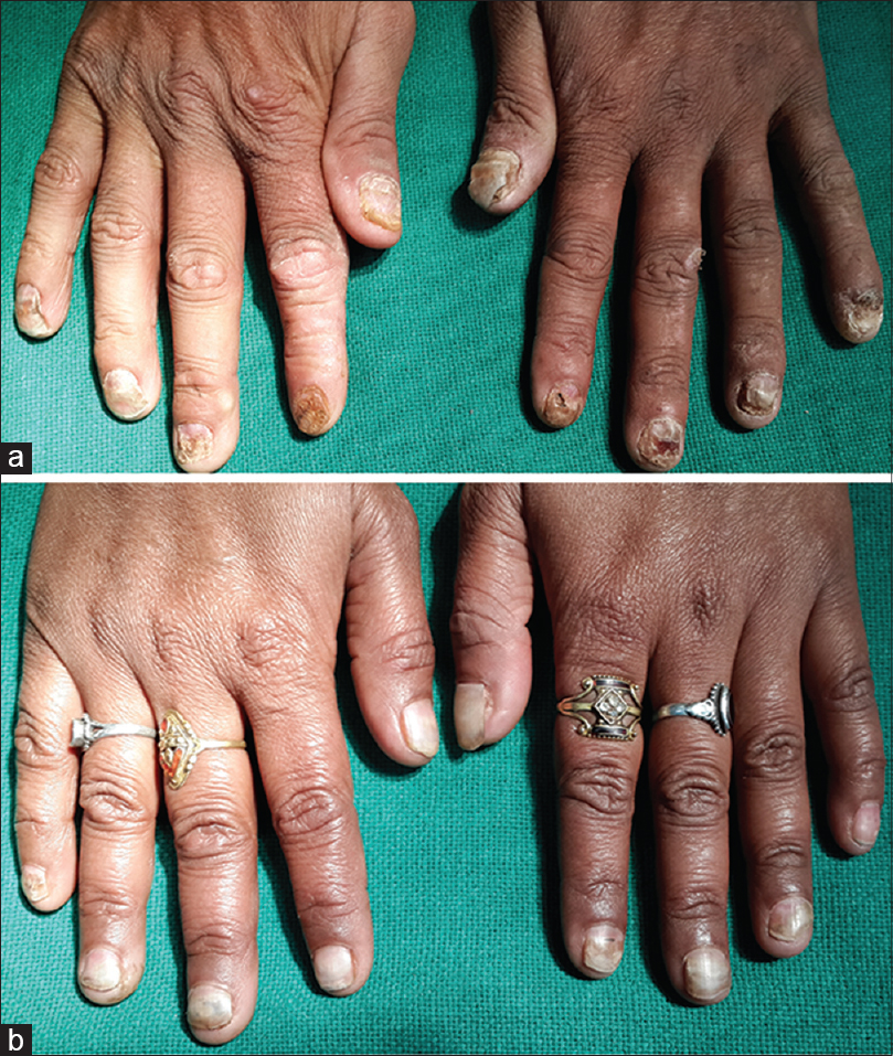 Selenium Toxicity A Rare Diagnosis Indian Journal Of Dermatology Venereology And Leprology